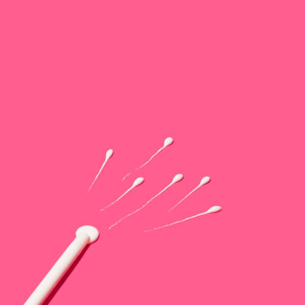 Espermatozoides siendo introducidos en el útero durante un tratamiento de inseminación artificial (IA).
