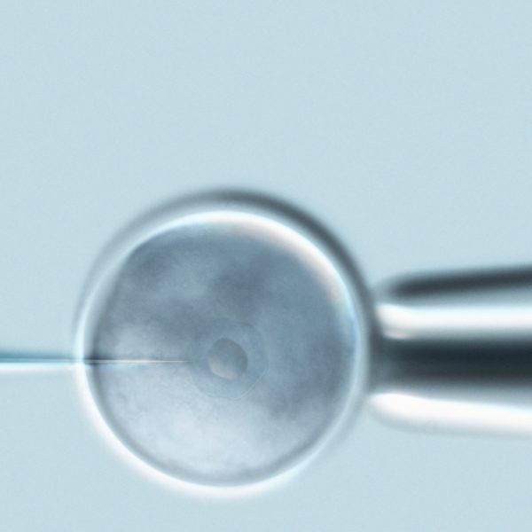Microinyección intracitoplasmática de espermatozoides (ICSI) en un óvulo, parte de un tratamiento de fertilización in vitro.